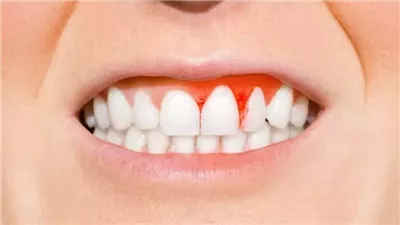 طرق علاج اللثة الملتهبة